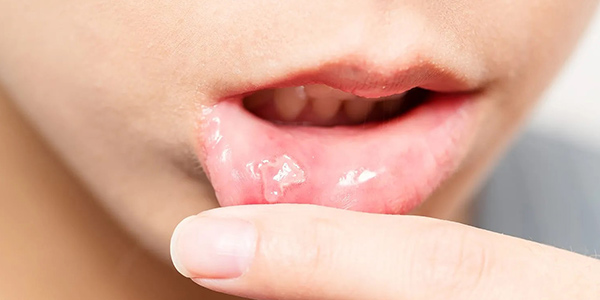 علاجات منزلية فعالة لتقرحات الفم
